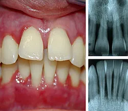 A periodontitis - okai, tünetei, diagnózisa és kezelése