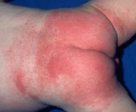 dermatita de scutec, erupții cutanate de căldură, purpură