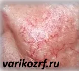 Peeling rosacea előnyei és hátrányai