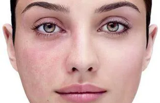 Peeling rosacea, amely lehet tenni otthon