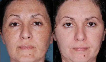 Peeling rosacea, amely lehet tenni otthon