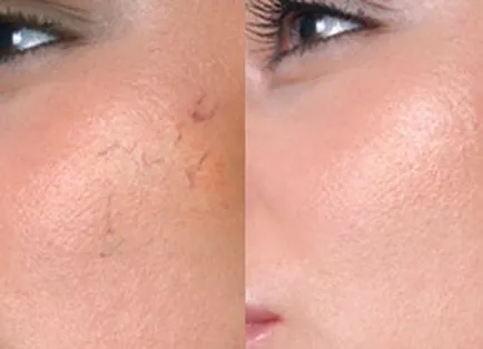 Peeling rosacea fajtái és jellemzői a kábítószerek