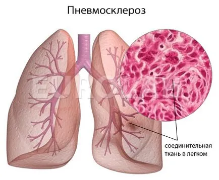 fibroza pulmonara - simptome ale bolii, prevenirea și tratamentul fibrozei pulmonare, cauzele bolii si sa