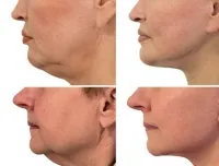 Facelift tippek Andrew iskorneva