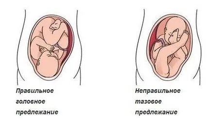 Subluxatio A csípőízület újszülöttek okoz, kezelési módszerek