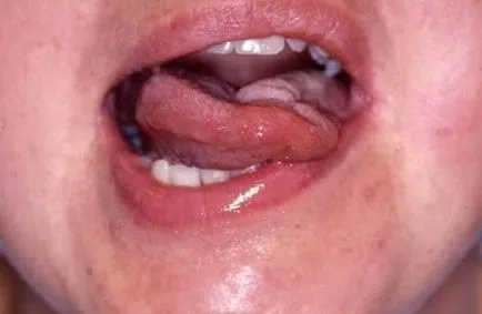hypoglossus