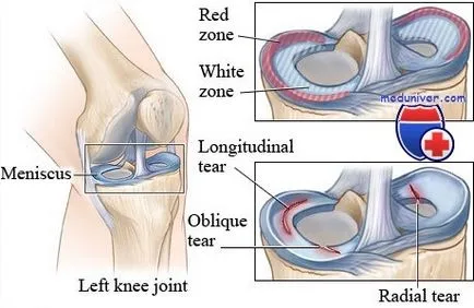 Deteriorarea meniscul articulației genunchiului