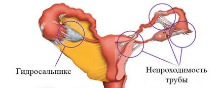Jelek gidrosalpinksa és alapvető módszereit diagnózis és kezelés