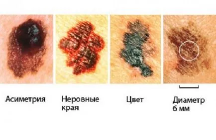 Причини за възникване на рак на кожата след солариум и пряка слънчева светлина