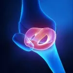 Decalajul a ligamentelor genunchiului - Simptome, tratament și reabilitare