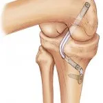 Decalajul a ligamentelor genunchiului - Simptome, tratament și reabilitare