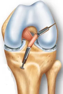 Decalajul a ligamentelor genunchiului - Simptome, tratament și reabilitare