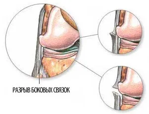 Decalajul a ligamentelor genunchiului - Simptome, tratament și reabilitare