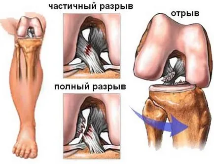 Decalajul a ligamentelor genunchiului - Simptome, tratament și reabilitare