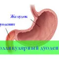 Дуоденит рефлукс причини, симптомите и лечението