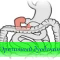 Duodenita cauze de reflux, simptome și tratament