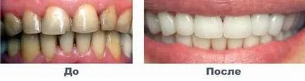 Restoration tömôanyagokkal Dental - Fogorvos - cikkek Directory - Dental