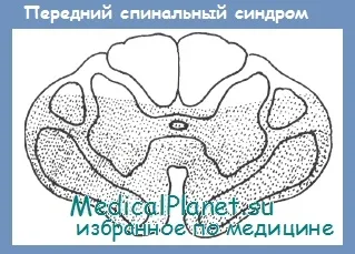 Травма на гръбначния мозък - клинична картина, диагноза
