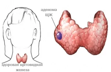 Mérgező adenoma a pajzsmirigy - azaz okoz, kezelés műtét nélkül