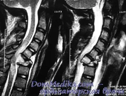 leziuni ale coloanei (măduvei spinării) - tablou clinic, diagnostic