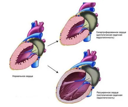 Симптомите на сърдечна недостатъчност, знаци и лечение на народната медицина