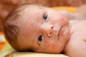Kiütés az arcon az újszülött formájában fehér foltok és piros foltok okoz, típusok tényezők
