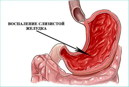 A tünetek a gyomorhurut fokozott szekréció