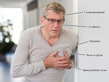 Sinus bradycardia - besorolás, okok, tünetek, elsősegély és kezelés