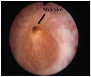 Ureteral strictura - ceea ce este această boală și care sunt motivele pentru dezvoltarea sa