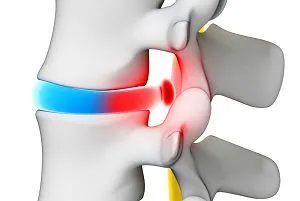 Subligamentarnaya диск херния какво е и какво е опасен