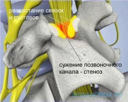 Намаляването на гръбначния канал - спинална стеноза