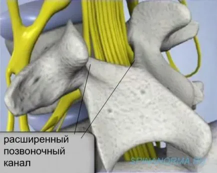 Ingustarea canalului spinal - stenoza spinarii