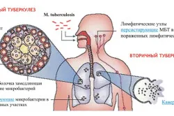 туберкулоза устната