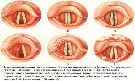 туберкулоза устната