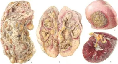 Tuberculoza simptome renale si de tratament cum au fost transmise