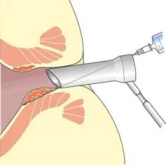 Изтриване на външни хемороиди - методи за хирургическа намеса - настройка на здравето