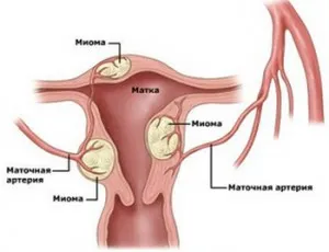 perioada postoperatorie histerectomie