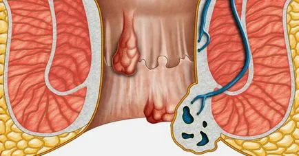 Изтриване на външни хемороиди - методи за хирургическа намеса - настройка на здравето