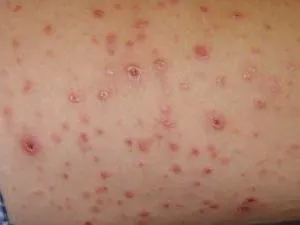 Vasculitis - lézió az érfalak