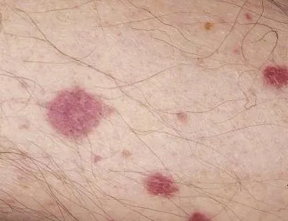 Vasculitis - lézió az érfalak