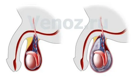 Varicocele hatásai a műtét után a herék varicocele férfiaknál