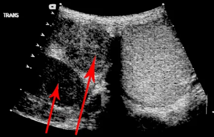 Ultrasunete de testicule la bărbați