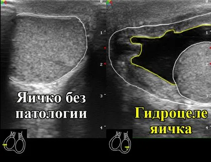 Ultrasunete de testicule la bărbați