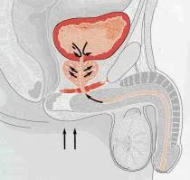 simptome veziculelor, cum ar fi dureri de prostata, cum să trateze și prognoza pentru bărbați