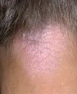 Inflamație a foliculilor de par pe scalp, piese pubian