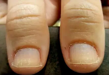Възпалените пръст разменяйте - причини, симптоми, отколкото лечение
