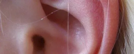 Рехабилитация и протезиране на ухото, ухото силиконови протези, корекция на дефекти за уши