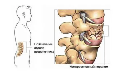 Complicații posibile și consecințe ale fracturilor vertebrale (compresiune, proces transversal)