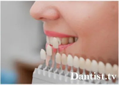 Смятате фасети за зъби са вредни - за красотата на душата
