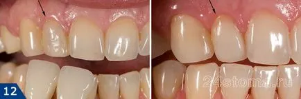 Смятате фасети за зъби са вредни - за красотата на душата